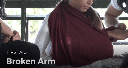 Video: broken arm